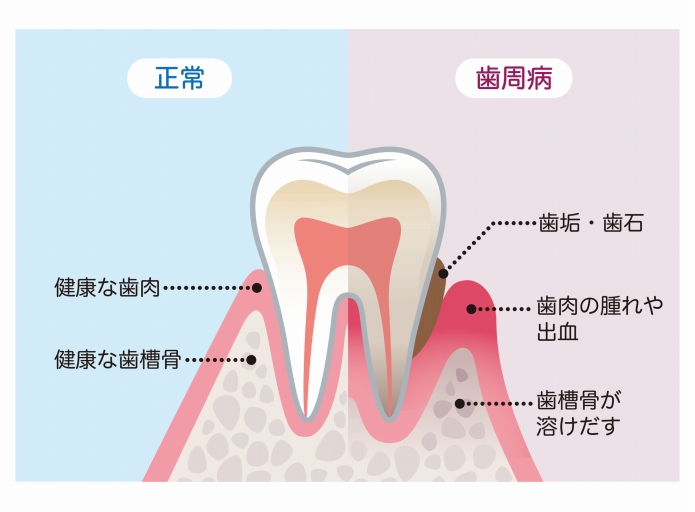 歯を失う可能性がある歯周病